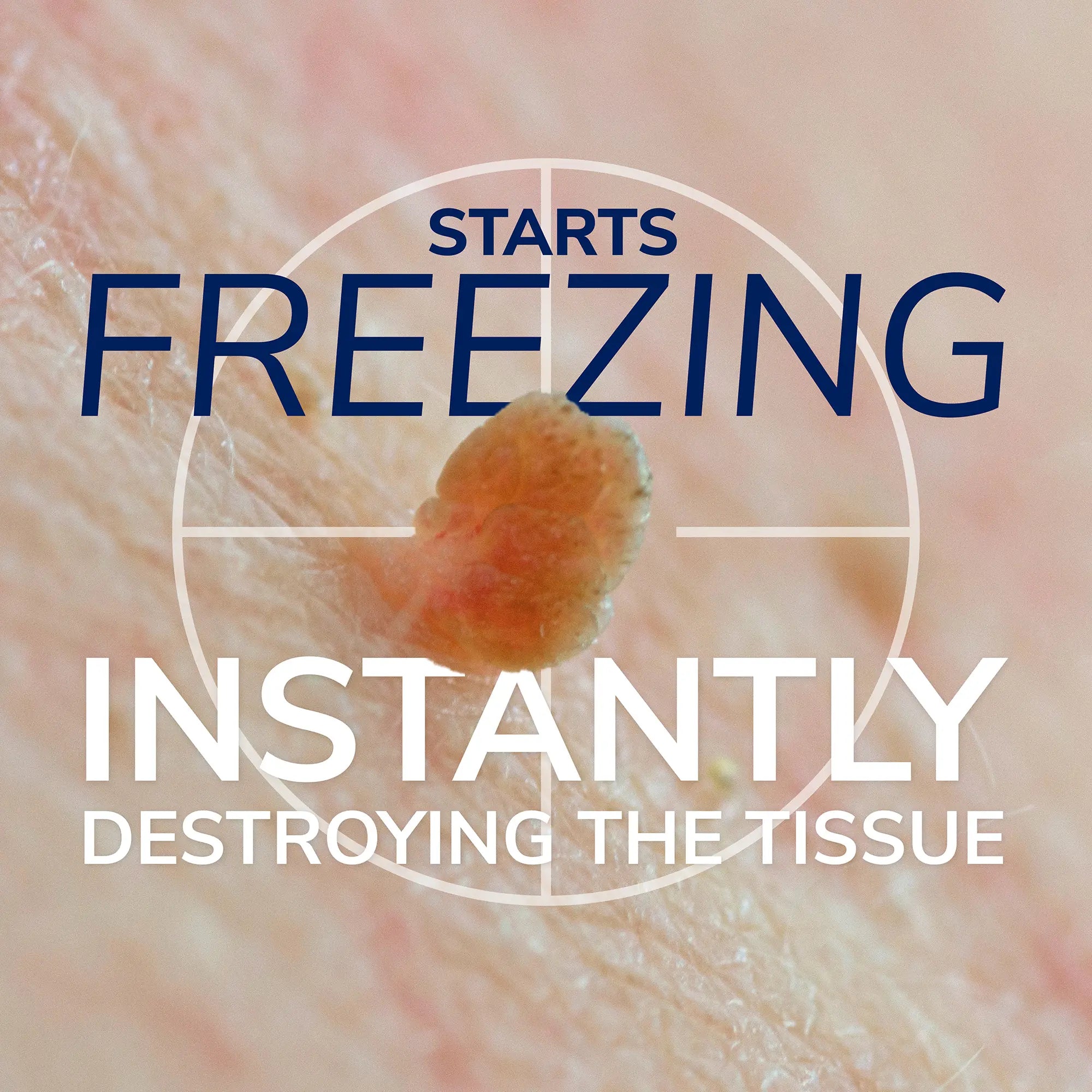 Freeze Away Skin Tag Remover - Image 5